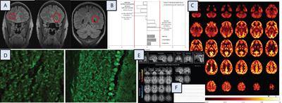 Case Report: Possible autoimmune obsessive-compulsive disorder with postpartum onset